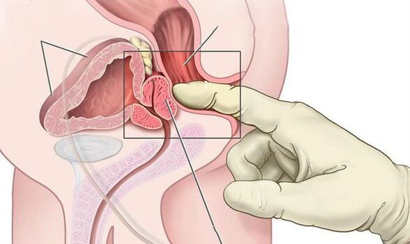 exame dixital rectal da próstata