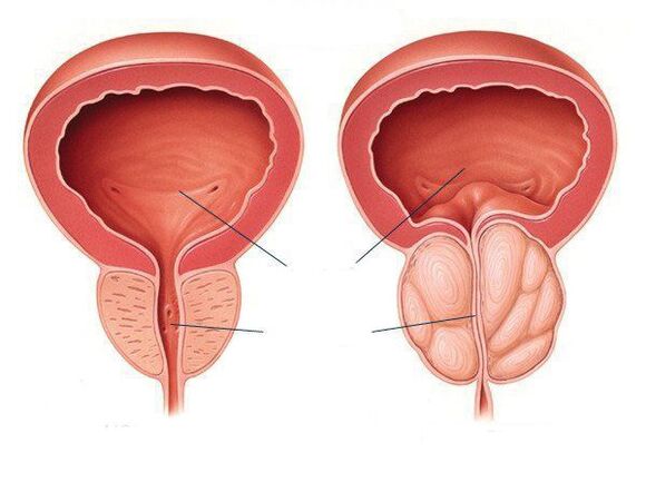 inflamación normal da próstata e da próstata