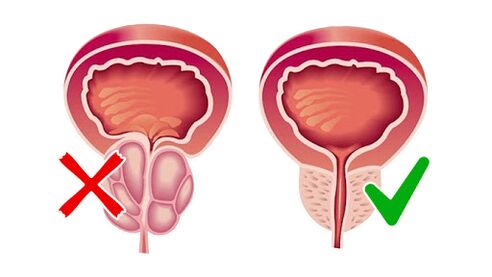 próstata antes e despois de usar Prostaline